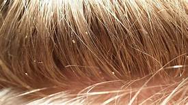 Can Pets Catch Head Lice?