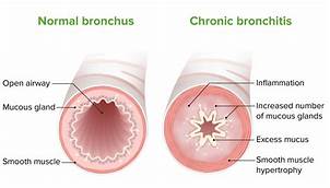 Can Pet Dander Cause Bronchitis?