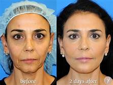 What is a Pet Lift Face Lift?